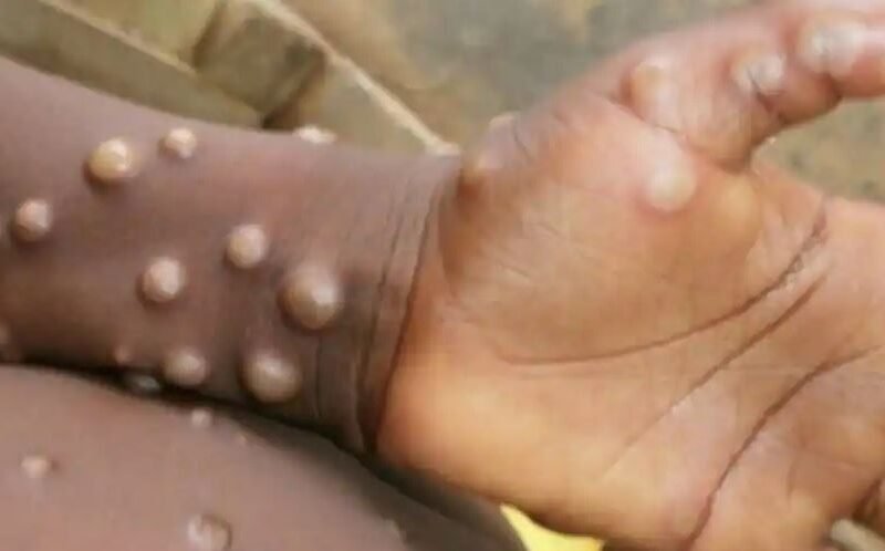 Monkeypox, monkeypox cases, Tamil Nadu, TN, Monkeypox in India, Monkeypox scare