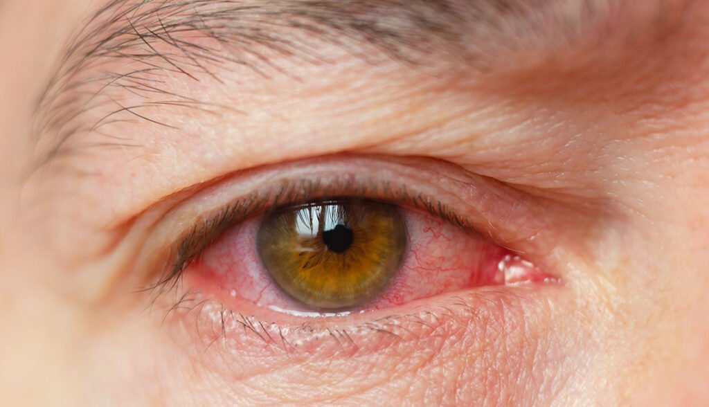Pink eye emerges as new Covid symptom